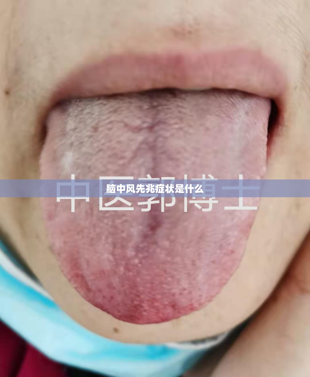 脑中风先兆症状是什么/脑中风先兆症状是什么样的 脑中风先兆症状是什么/脑中风先兆症状是什么样的